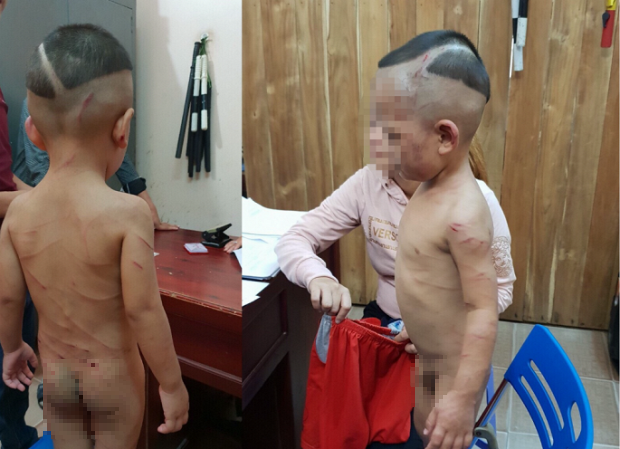 Bé H. có những vết thương chi chít khắp Sh88bet đăng ký miễn phí