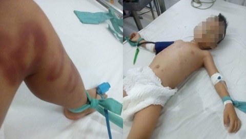 Bé trai mình đầy thương tích, hôn mê nguy kịch