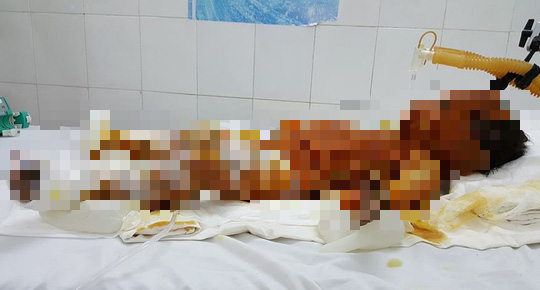 Bé đang được thở máy, truyền dịch và thuốc trợ tim mạch.