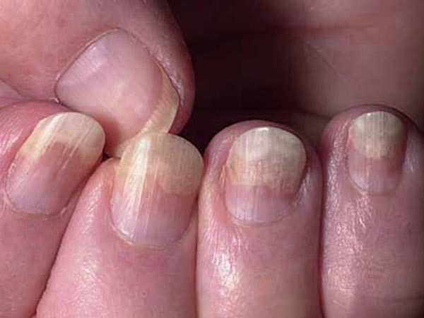 Nếu móng tay của bạn tự nhiên thay đổi màu sắc đó là dấu hiệu bạn mắc bệnh liên qun tới tim mạch