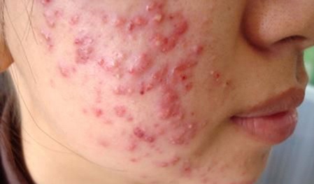 Hàng nghìn người cảm thấy bế tắc trong tìm giải pháp trị mụn trứng cá