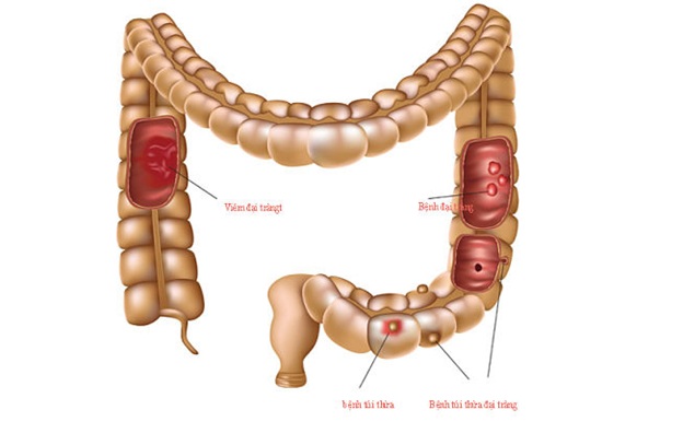 Viêm đại tràng dễ biến chứng thành ung thư đại tràng
