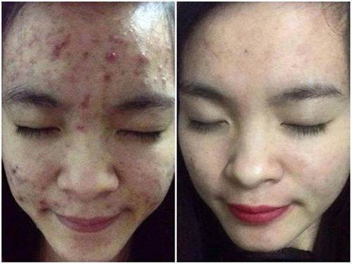 Mặt nạ từ bia giúp bạn trị mụn hiệu quả