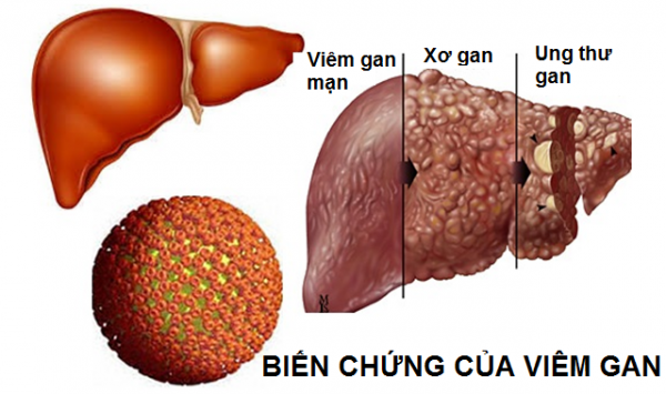 dieu-tri-viem-gan-foritex-600x355