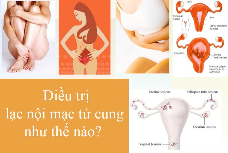 500x337xendometriosis-mich-1-728.jpg.pagespeed.ic.DdK8VNOR5Y