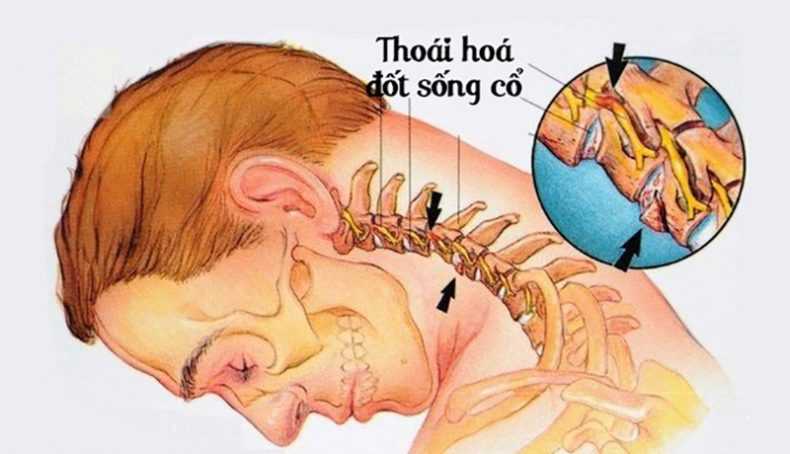 dau-hieu-thoai-hoa-dot-song-co-2