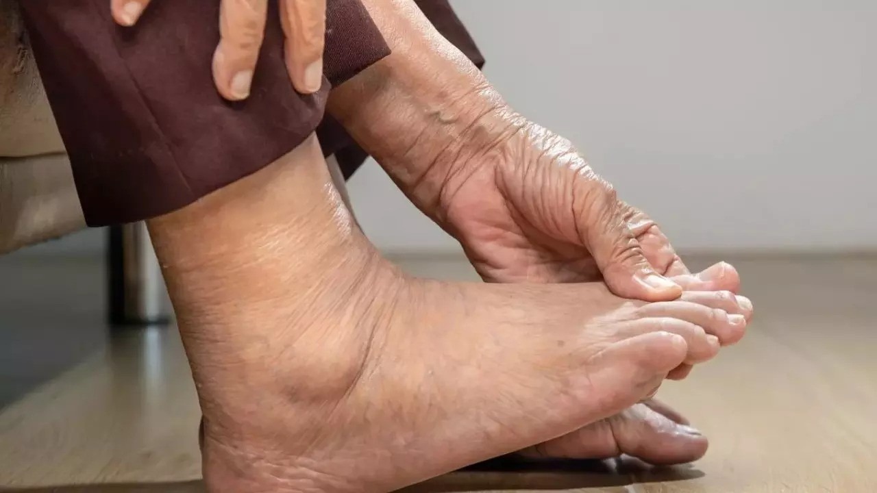 Các bác sĩ cho biết, tình trạng tuần hoàn máu suy giảm do tim hoạt động kém có thể bộc lộ qua ba dấu hiệu bất thường ở chân. Ảnh minh họa