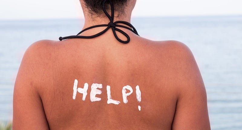 sunburn-2