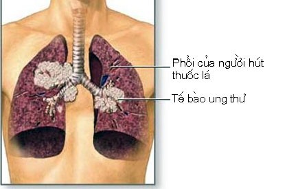 7dau-hieu-ung-thu-phoi1