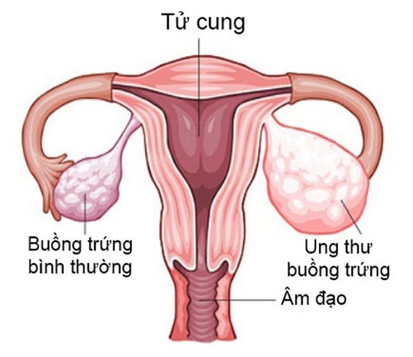 ung-thu-buong-trung