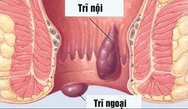 benh-tri-1