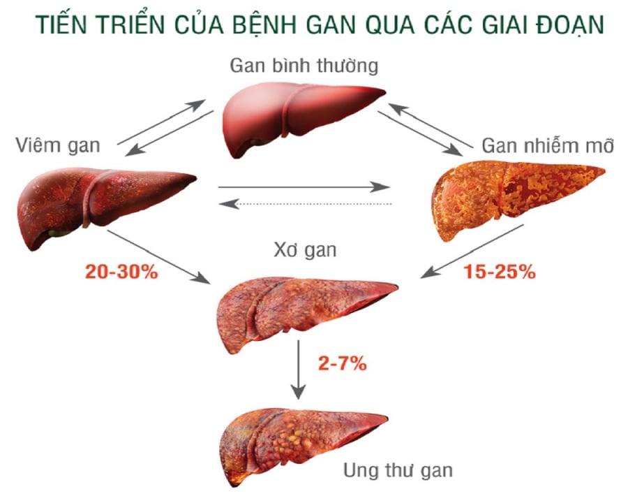 gan-nhiem-mo-phunutoday