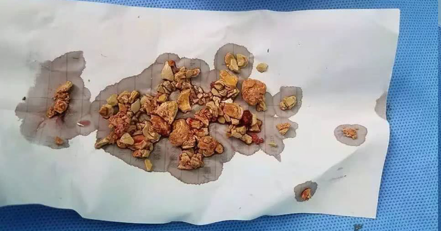 Những viên sỏi được gắp ra khỏi Sh88bet đăng ký miễn phí béXiaowen