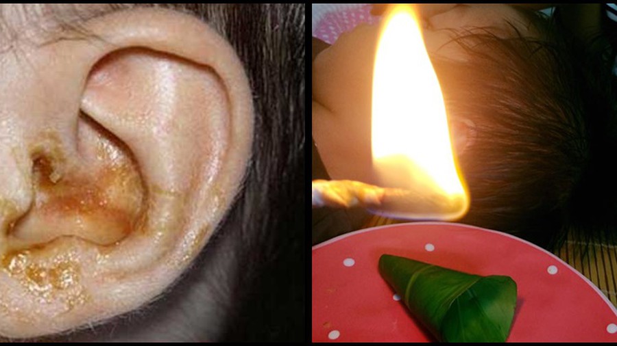 Tự chữa viêm tai giữa cho con gây nhiều mối nguy hại khôn lường.