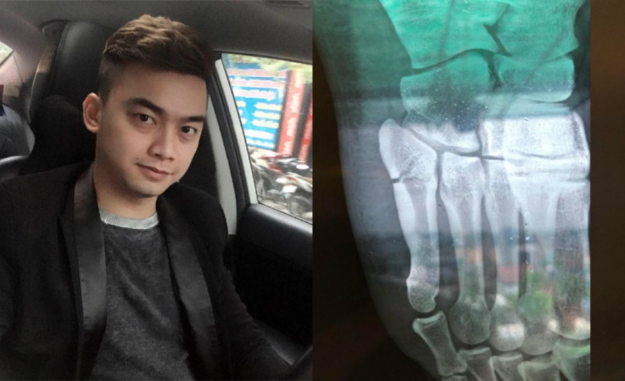 Mới đây, cựu diễn viên đình đám một thời Hà Duy khiến người quan tâm lo lắng khi tiết lộ về tình trạng sức khỏe của mình. Theo chia sẻ của con trai NSƯT Hương Dung thì anh bị ngã. Sau khi đi khám và chụp chiếu, bác sĩ chẩn đoán anh bị Shbet16 tỷ lệ cá cược bóng đá bàn chân phải. Hiện tại, Hà Duy đang được điều trị bằng phương pháp bó lá. (2sao.vn)