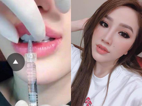 Hình ảnh tiêm môi được cho là của Bảo Thy khiến dư luận xôn xao và làm rộ lên nghi vấn nữ ca sĩ can thiệp dao kéo.