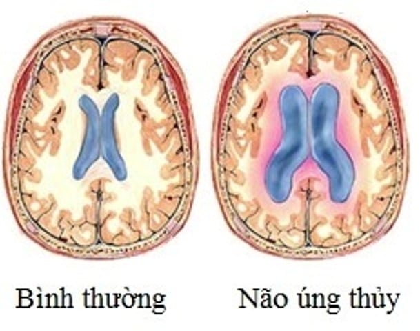 nao ung thuy 1