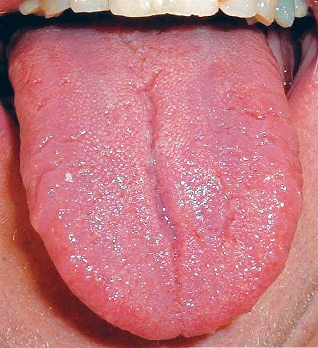 benh-1