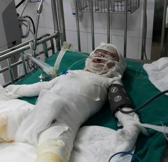 Cháu bé trong những ngày chữa trị tại viện bỏng.