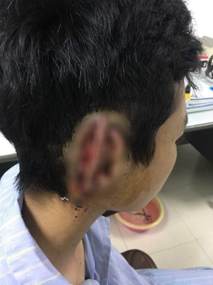 Nam sinh T. bị đứt tai phải.  