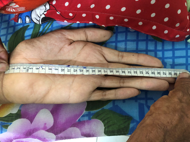 Bàn tay dài gần 30 cm của anh Trung.  