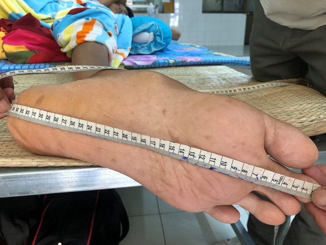 Bàn chân to dị thường của anh Trung.