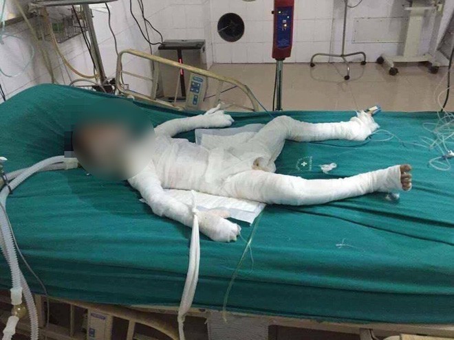 Cháu K. bị bỏng nặng toàn thân, mất rạng sáng ngày 13/10.  
