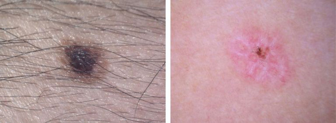 uneven-color-moles-skin-cancer-1527709587-15280999258281500367284