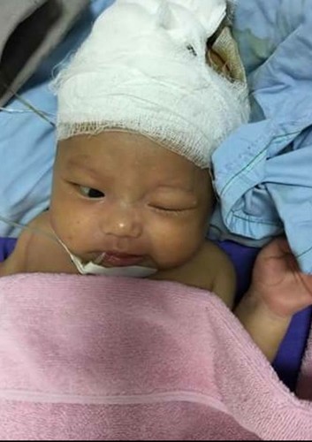 quang-ninh-phau-thuat-ghep-so-nao-thanh-cong-cho-be-trai-37-ngay-tuoi-sharoncuneta.com