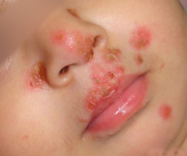 canh-bao-be-trai-1-tuoi-nhiem-loai-virus-ca-doi-khong-the-chua-khoi-chi-vi-thoi-quen-nay-cua-nguoi-lon-3