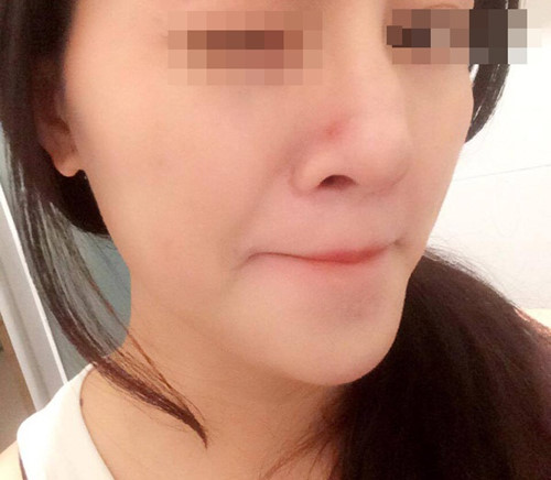 co-gai-bi-dot-quy-mu-mot-mat-sau-khi-tiem-filler-nang-mui-sharoncuneta.com-3