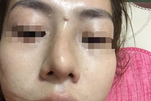 co-gai-bi-dot-quy-mu-mot-mat-sau-khi-tiem-filler-nang-mui-sharoncuneta.com-5