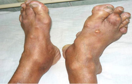 mac-benh-gout-vi-nghien-noi-tang-lon-sharoncuneta.com-2
