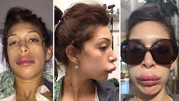 Ngôi sao truyền hình thực tế Farrah Abraham là ví dụ tiêu biểu của 