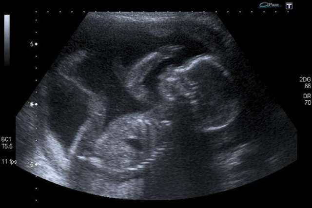 nhung-dieu-me-can-biet-ve-tuan-mang-thai-thu-20-unborn_baby_at_20_weeks_credit_steve_via_flickr_cc-1521201076-77-width640height427