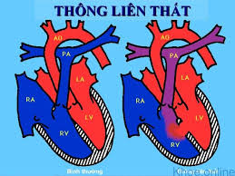 tl