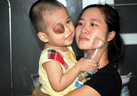 Thương quặn lòng cháu bị bị ung thư võng mạc ở nghệ an