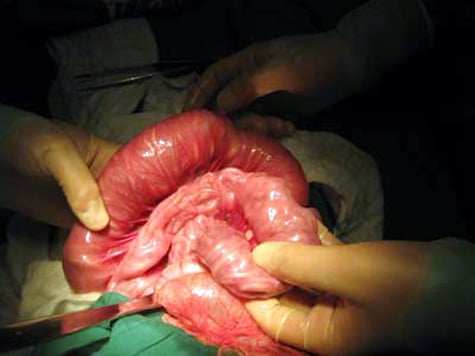 Mất 3 tiếng để gắp hết số giun trong bụng bé 3 tuổi