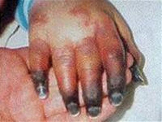 vi khuẩn ăn thịt người