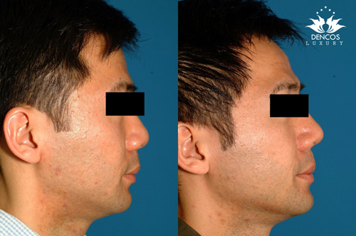Đối với phương pháp nâng mũi bằng filler, chỉ sau 60 phút bạn đã có thể thoát khỏi tình trạng mũi lõm.