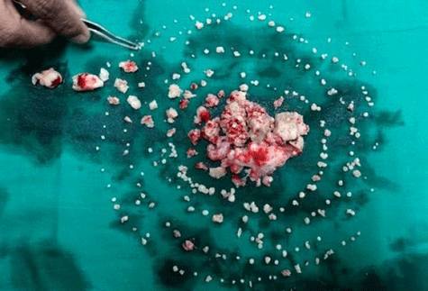 Cậu bé có 232 chiếc răng 