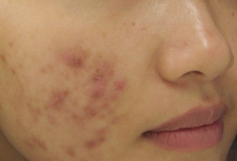 Cách trị mụn trứng cá an toàn hiệu quả