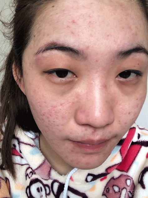 Hậu quả tiêm trắng da 