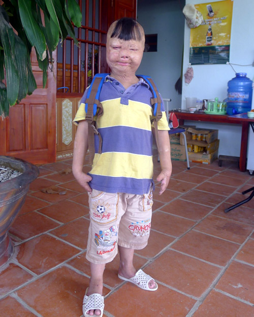 Cháu bé bị bố tưới xăng đốt suýt chết ước mơ làm bác sĩ