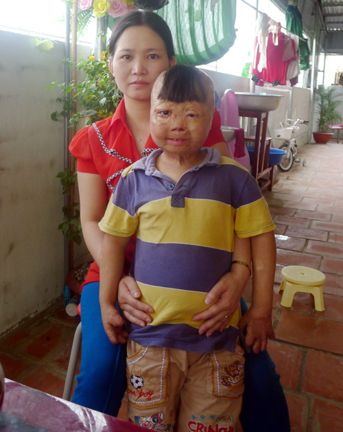 Cháu bé bị bố tưới xăng đốt suýt chết, mẹ bị gạ tình ước mơ làm bác sĩ