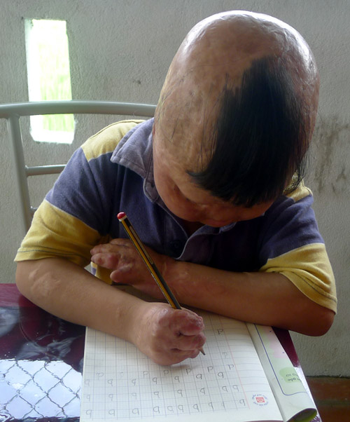 Cháu bé bị bố tưới xăng đốt suýt chết, mẹ bị gạ tình ước mơ làm bác sĩ
