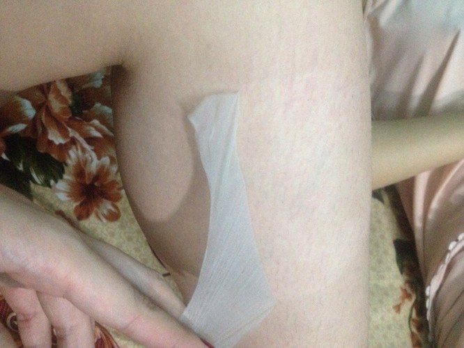 kem làm trắng da gây ung thư
