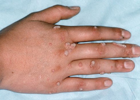 Trị mụn cóc