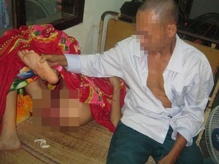 bé trai tàn tật bị bạo hành