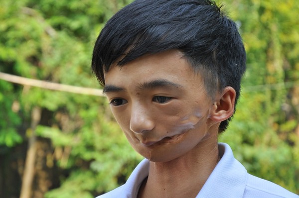 ung thu